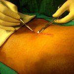 Surgery