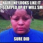 UGLY HAIRLINE  | HAIRLINE LOOKS LIKE IT GOT SLAPPED UP BY WILL SMITH; SURE DID | image tagged in ugly hairline,funny,will smith,slap | made w/ Imgflip meme maker