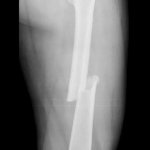 Femur fracture