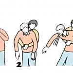 Emergency procedure for when someone is choking