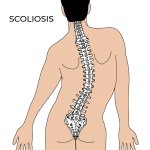 Scoliosis - POSTURE GEEK