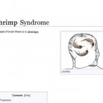 shrimp syndrome