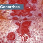 Perry PhD JPP Oral STD VD gonorrhea