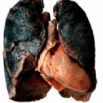 Asthma lung template