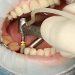 Mouth surgery