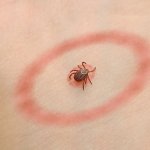 Lyme Disease caused by US Gov.