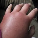 Swollen Hand