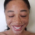 freckles