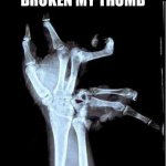 Oof | I MIGHT’VE BROKEN MY THUMB; SO… YA | image tagged in broken hand | made w/ Imgflip meme maker