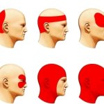 Headache Types template