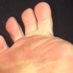 Missing toe