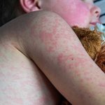 measles child