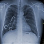 hemostat on chest xray