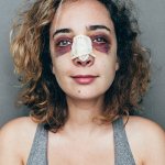 woman black eyes broken nose abused