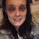 woman with two black eyes MAGA