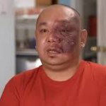 Man with Birth Mark on Face