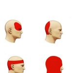 Types of Headaches