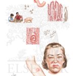 Trichinosis (Parasitic Heart Disease)