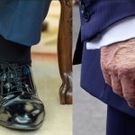 Trump cankles and bruised hand makeup