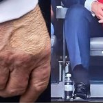 Trump cankles and bruised hand makeup