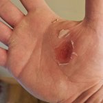 Blistered hand template