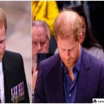 Bald Prince Harry