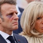 Emmanuel Macron with Black Eye