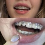 #braces meme