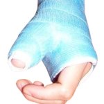 Broken hand cast