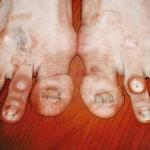 Ugly Feet