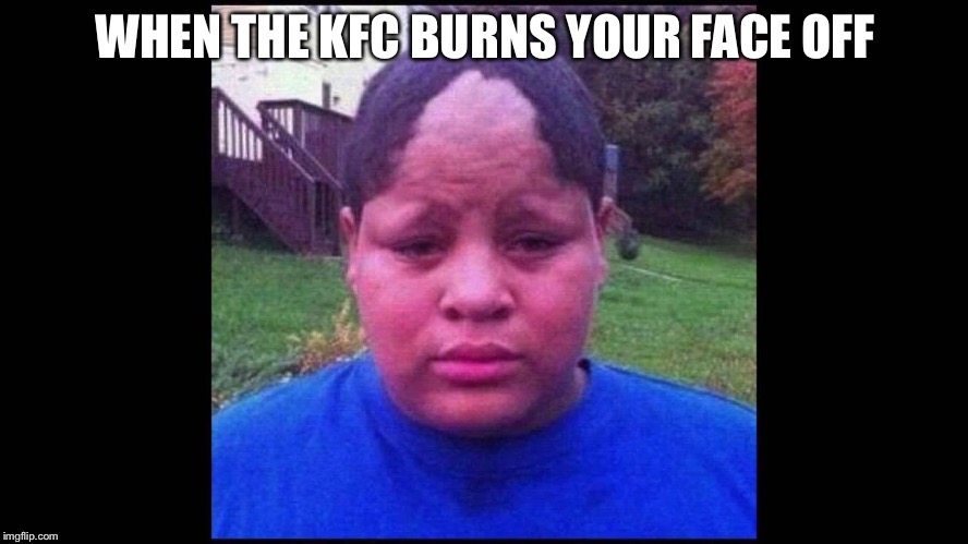 Chicken boy | WHEN THE KFC BURNS YOUR FACE OFF | image tagged in ugly hairline,kfc,alah,damn,funny,meme | made w/ Imgflip meme maker
