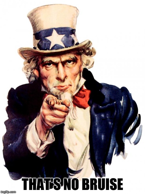 Uncle Sam Meme | THAT'S NO BRUISE | image tagged in memes,uncle sam | made w/ Imgflip meme maker