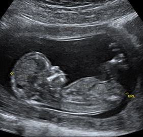 Sonogram Blank Meme Template