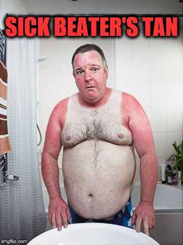That's gotta hurt! | SICK BEATER'S TAN | image tagged in beater's tan,wife beater,sunburn | made w/ Imgflip meme maker