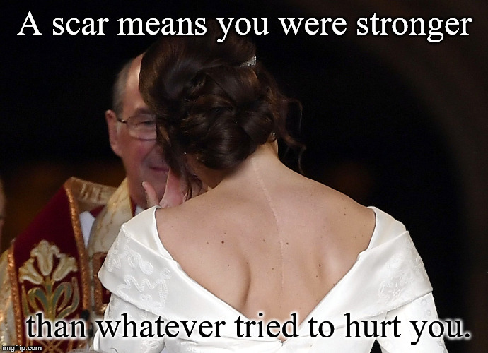Eugenie wedding statement | A scar means you were stronger; than whatever tried to hurt you. | image tagged in eugenie,princess,york,wedding,scoliosis,surgery | made w/ Imgflip meme maker