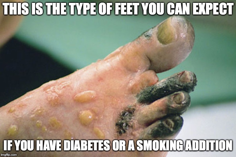 Infected Feet | THIS IS THE TYPE OF FEET YOU CAN EXPECT; IF YOU HAVE DIABETES OR A SMOKING ADDITION | image tagged in diabetes,smoking,memes,feet | made w/ Imgflip meme maker