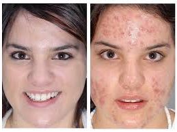 High Quality BEFORE AND AFTER ACNE MEME Blank Meme Template