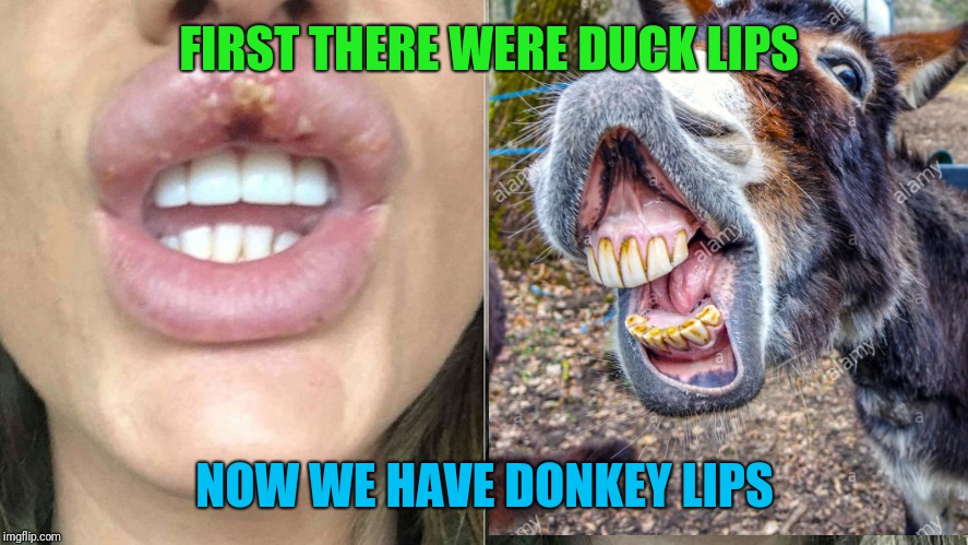 Botox: When Glueing An Inner Tube To Your Face Isn't Quite Practical | FIRST THERE WERE DUCK LIPS; NOW WE HAVE DONKEY LIPS | image tagged in botox,duck face,donkey,epic fail | made w/ Imgflip meme maker