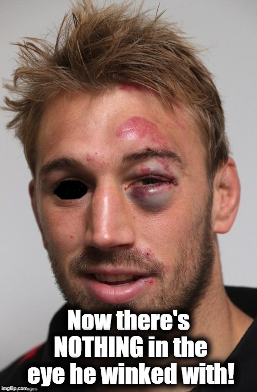 black eye | Now there's NOTHING in the eye he winked with! | image tagged in black eye | made w/ Imgflip meme maker