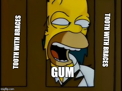 Heeres Homer | TOOTH WITH BRACES TOOTH WITH BRACES GUM | image tagged in heeres homer | made w/ Imgflip meme maker