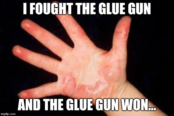 Burned Hands | I FOUGHT THE GLUE GUN; AND THE GLUE GUN WON... | image tagged in burned hands | made w/ Imgflip meme maker