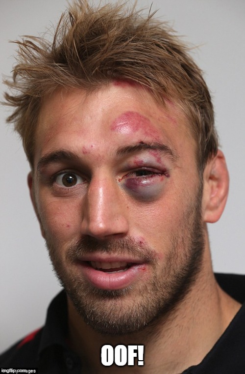 black eye | OOF! | image tagged in black eye | made w/ Imgflip meme maker