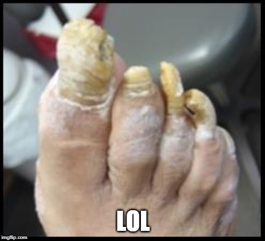 Ugly Toe Nails | LOL | image tagged in ugly toe nails | made w/ Imgflip meme maker