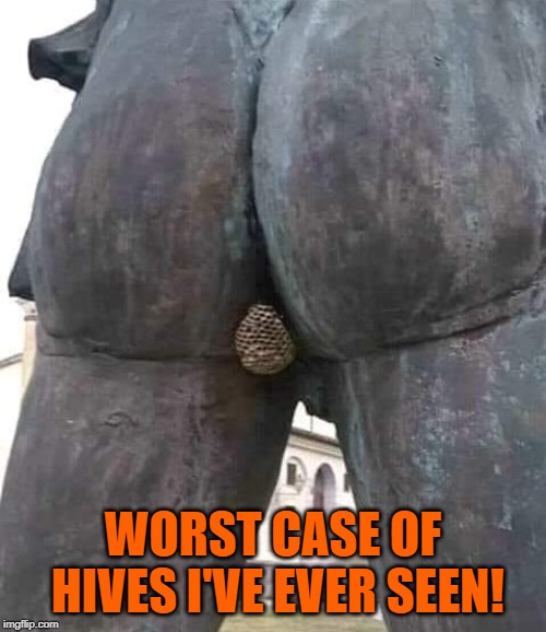 Damn! that itches! | WORST CASE OF HIVES I'VE EVER SEEN! | image tagged in funny hives,bad case of hives | made w/ Imgflip meme maker