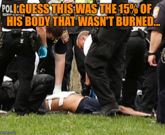 I GUESS THIS WAS THE 15% OF HIS BODY THAT WASN'T BURNED... | made w/ Imgflip meme maker