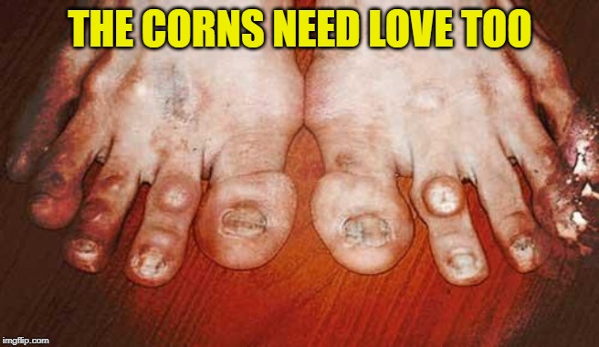 Ugly Feet | THE CORNS NEED LOVE TOO | image tagged in ugly feet | made w/ Imgflip meme maker