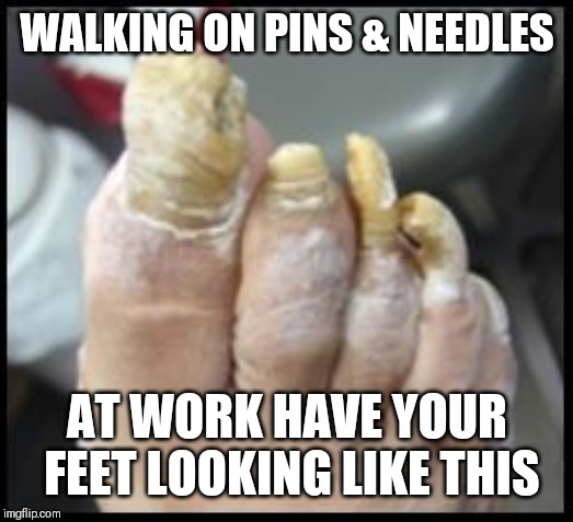 Jroc113 | WALKING ON PINS & NEEDLES; AT WORK HAVE YOUR FEET LOOKING LIKE THIS | image tagged in ugly toe nails | made w/ Imgflip meme maker