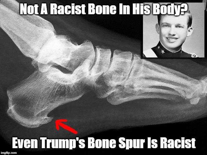 Not A Racist Bone In His Body? Even Trump's Bone Spur Is Racist | made w/ Imgflip meme maker