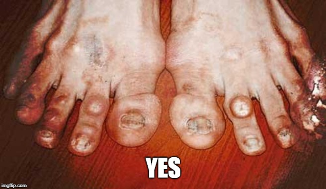 Ugly Feet | YES | image tagged in ugly feet | made w/ Imgflip meme maker