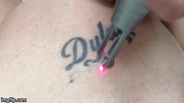 Picosecond Laser Tattoo Removal – SkyAish